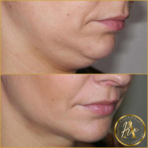 Collagen Biostimulators