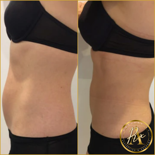 Collagen Biostimulators