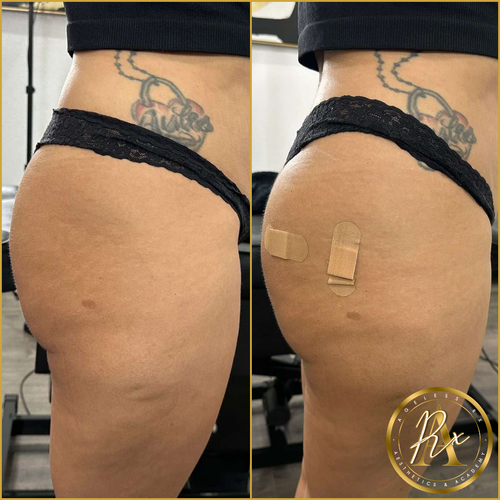Booty Enhancement