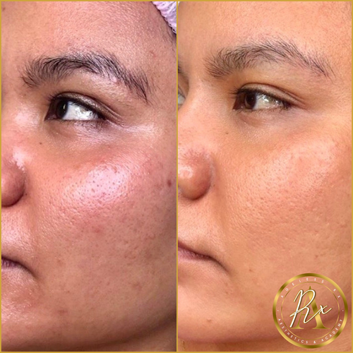 Chemical Peels