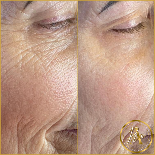 SKIN BOOSTERS