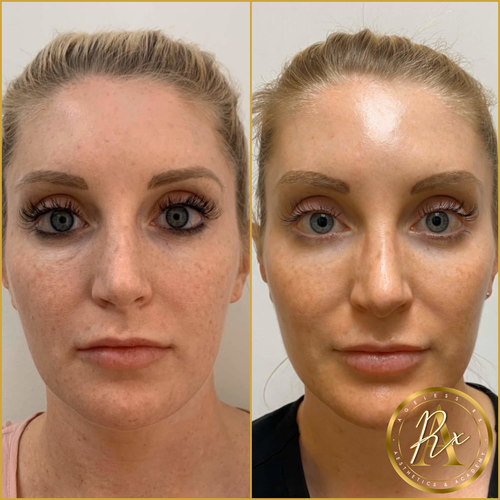 PRP/PRF + Biofiller