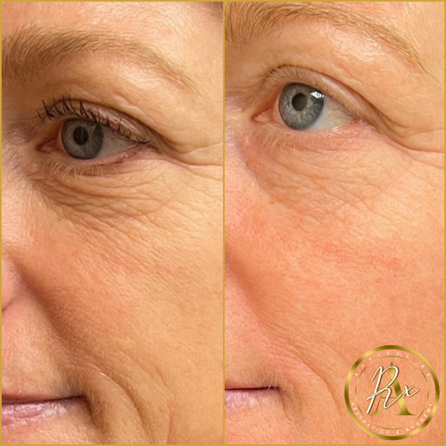 SKIN BOOSTERS