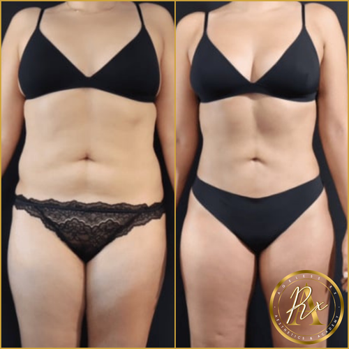 GLP-1 Weight Loss
