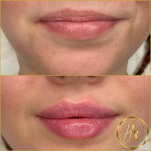 Dermal Filler