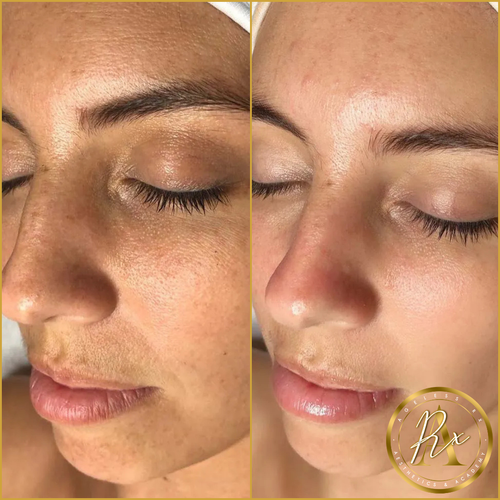 HydraFacial