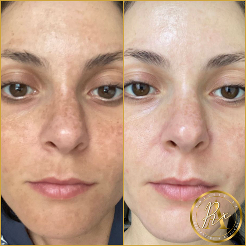 HydraFacial