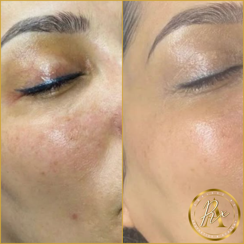 Chemical Peels