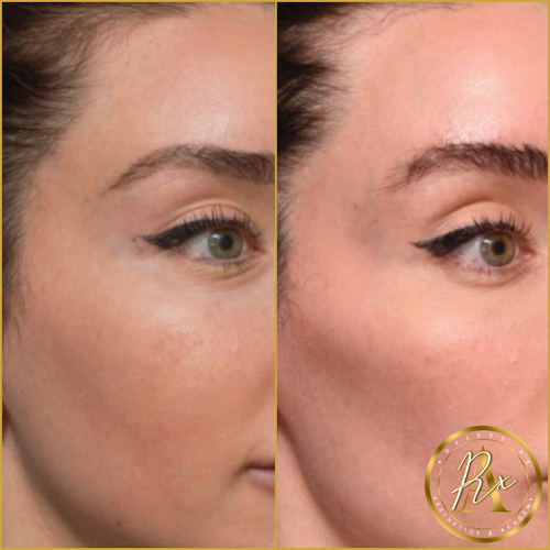 Dermal Filler