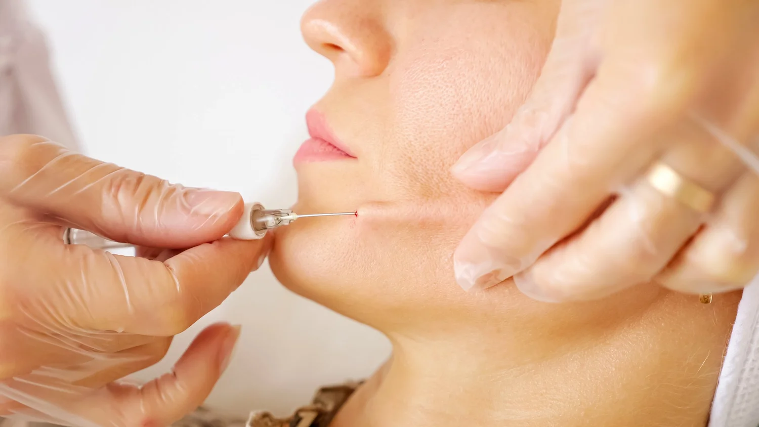 LEVEL 3 dermal FILLER